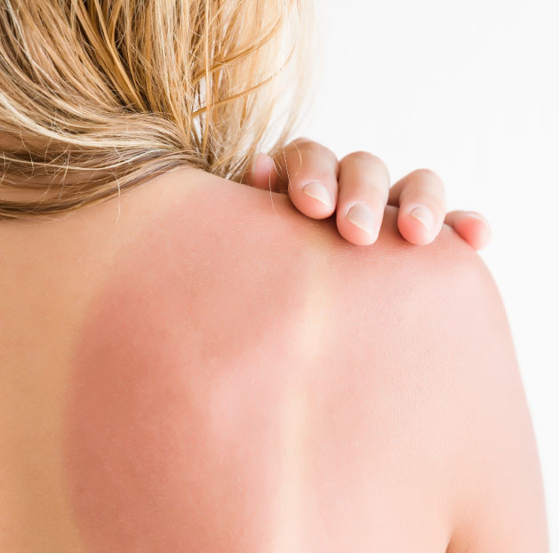 Câncer de pele: saiba quais são os riscos da exposição excessiva à luz solar e como reduzi-los